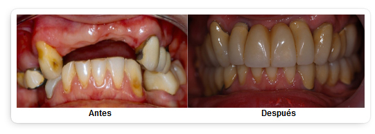 IMPLANTE DENTAL